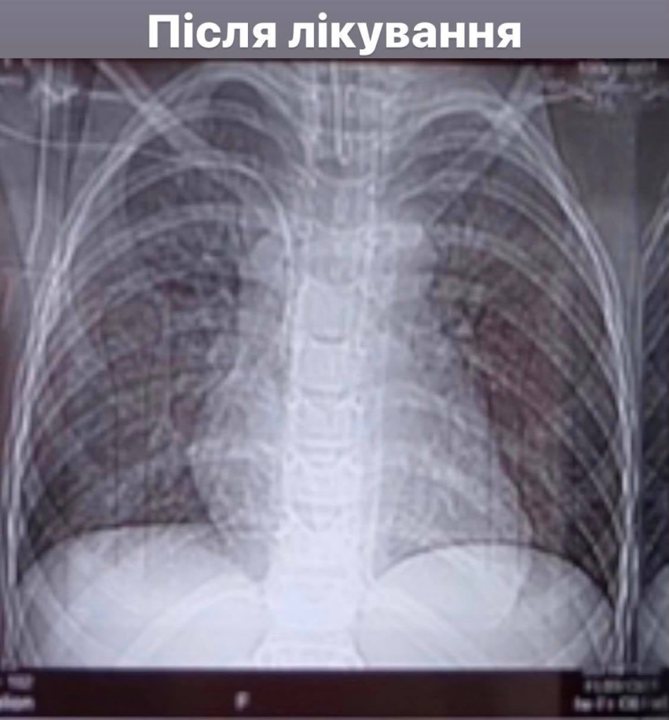 Франківські медики врятували 8-річного хлопчика, який два тижні був на ШВЛ з 85% ураження легень 2