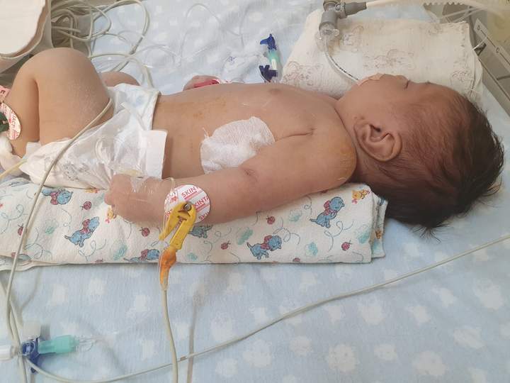 21 день від народження: крихітці Емілії з Прикарпаття успішно прооперували критичну ваду серця 1