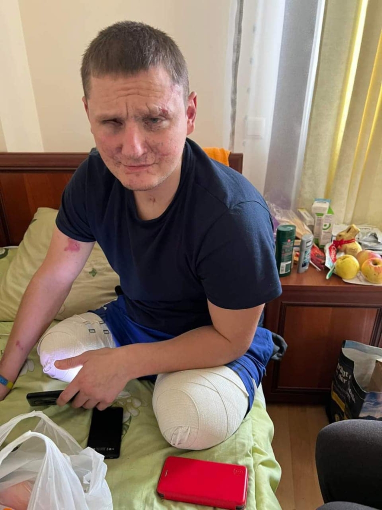 Десантника з Калущини, який втратив дві ноги на війні, протезують у США 1