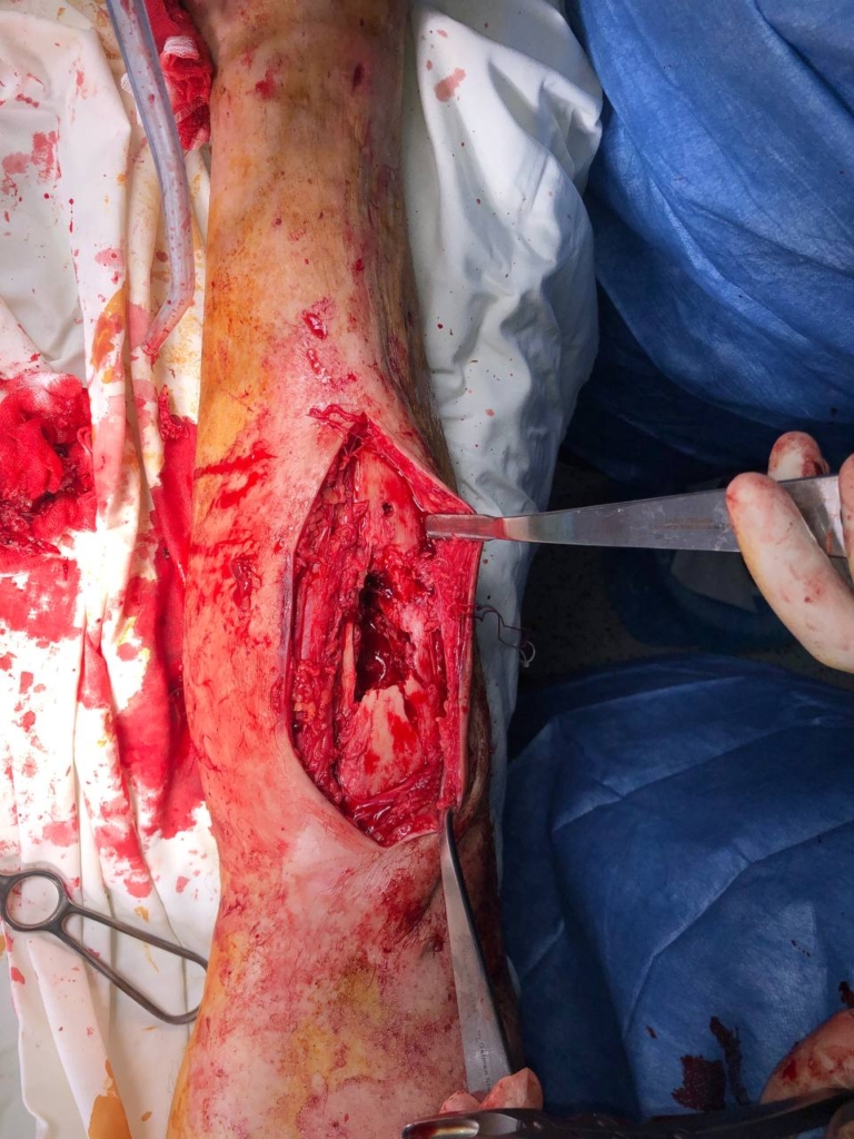 Пересадити кісткову тканину: як у франківській ЦМКЛ рятують ногу пораненому захиснику 2