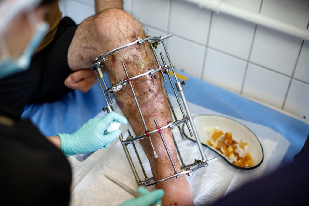 У Франківську пораненому бійцю нарощують 17 см кістки, щоб врятувати ногу від ампутації