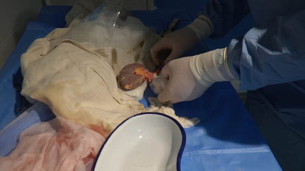 Вісім годин в операційній: у Франківській ОКЛ двом пацієнтам пересадили нирки від посмертного донора 1