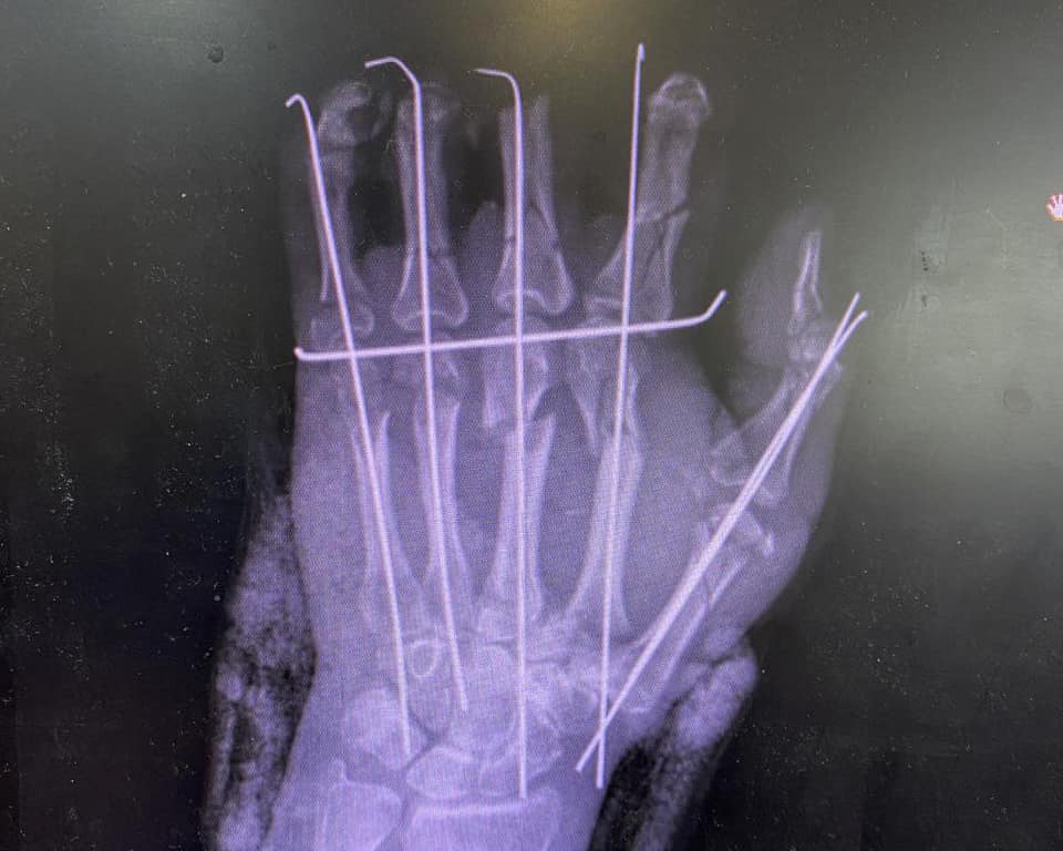 59-річній прикарпатці врятували руку, пошкоджену січкарнею 1