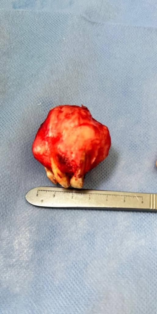 Франківські стоматологи-хірурги видалили пухлину розміром з тенісний м'ячик 1