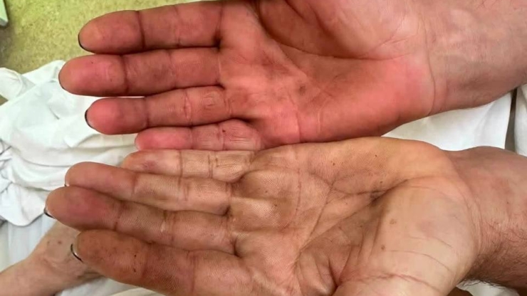 У Коломийській ЦРЛ успішно прооперували пацієнта з ураженням судинної системи